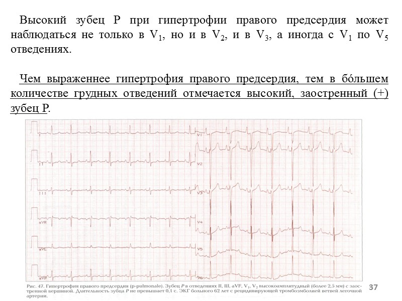 37 Высокий зубец Р при гипертрофии правого предсердия может наблюдаться не только в V1, 37 Высокий зубец Р при гипертрофии правого предсердия может наблюдаться не только в V1,
